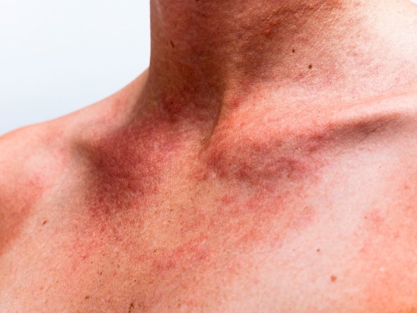 Что такое аллергический дерматоз?