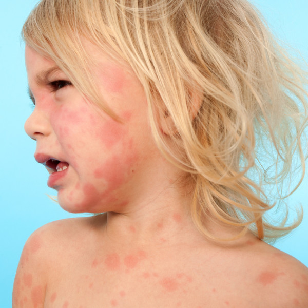 Аллергические проявления на коже у детей: чем опасны и что с этим делать?